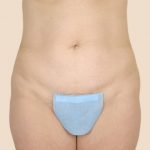 Tummy Tuck Before & After Patient #456