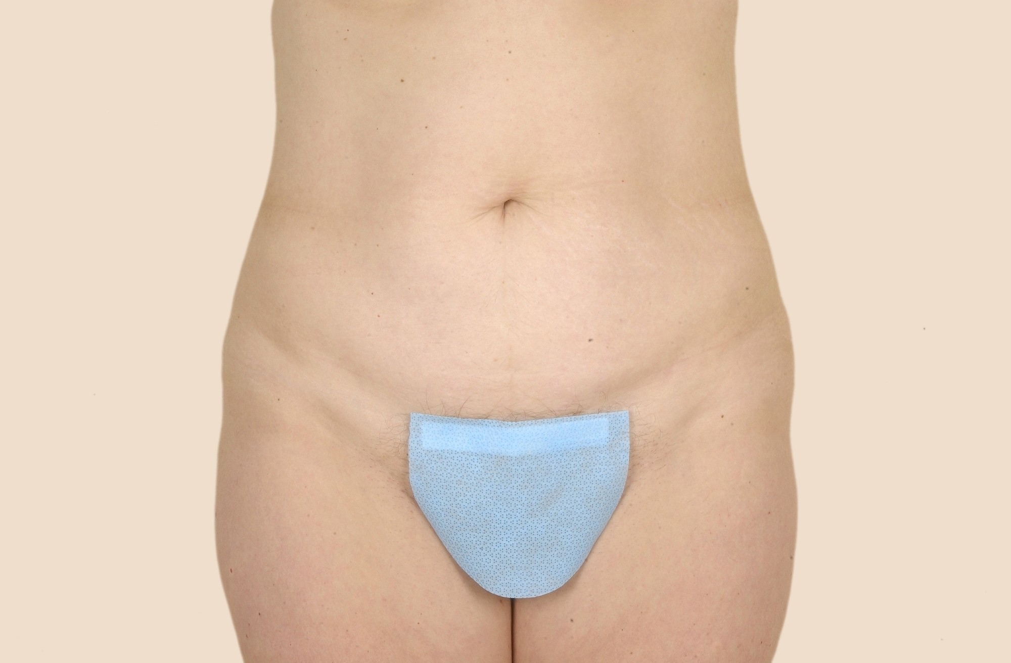 Tummy Tuck Before & After Patient #456