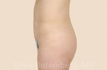 Tummy Tuck Before & After Patient #456