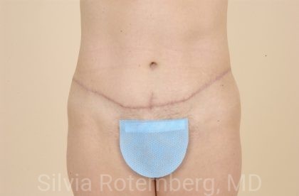Tummy Tuck Before & After Patient #456