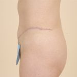 Tummy Tuck Before & After Patient #456