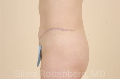 Tummy Tuck Before & After Patient #456