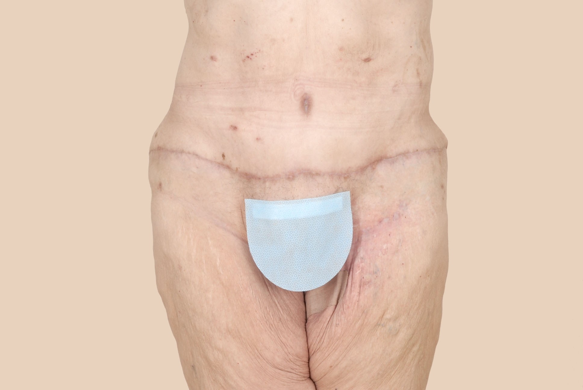 Tummy Tuck Before & After Patient #463