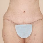 Tummy Tuck Before & After Patient #471