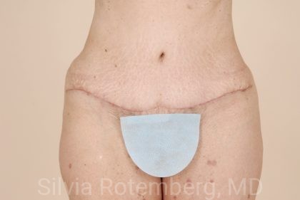 Tummy Tuck Before & After Patient #471
