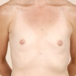 Breast Augmentation Before & After Patient #379