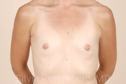 Breast Augmentation Before & After Patient #379