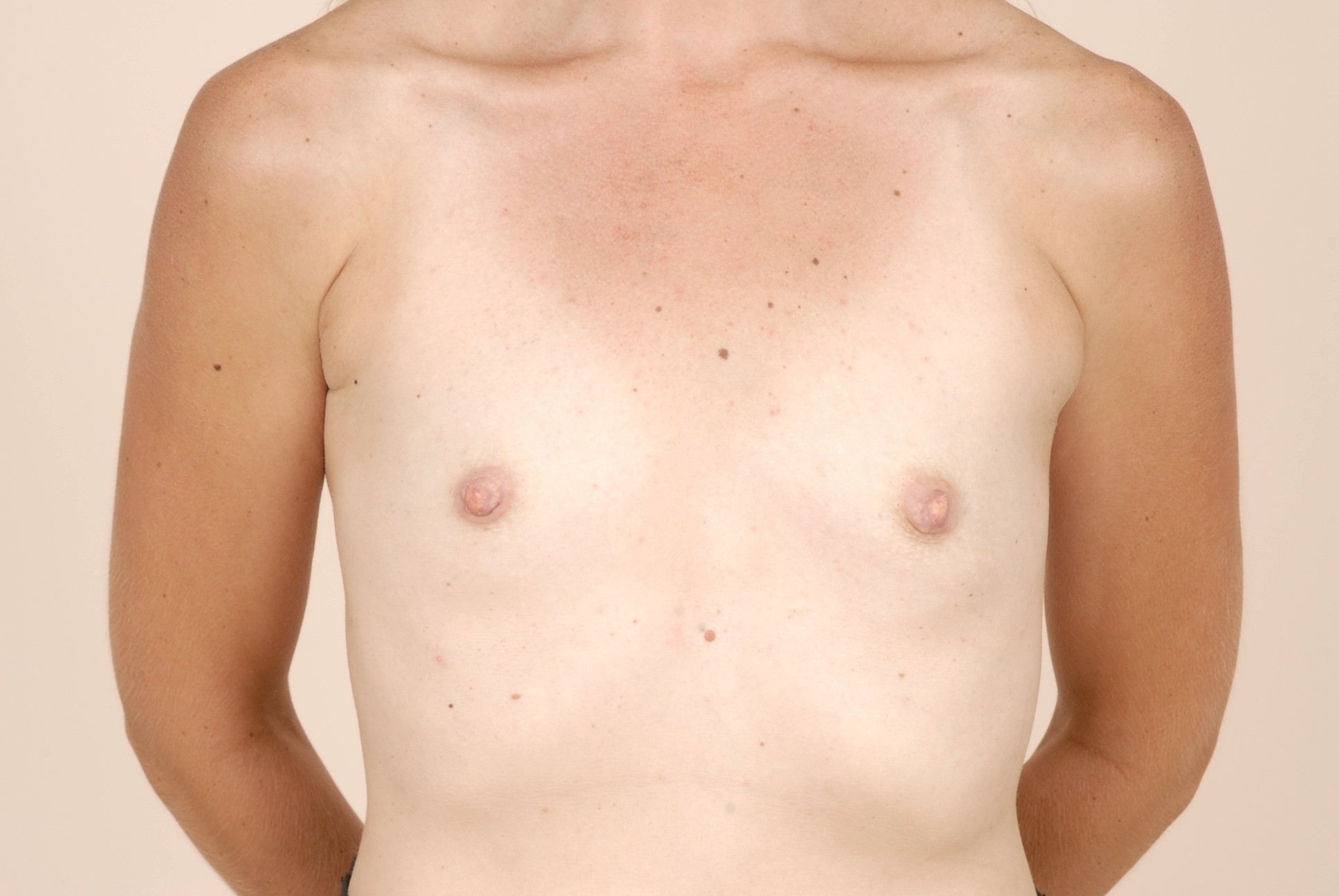 Breast Augmentation Before & After Patient #379