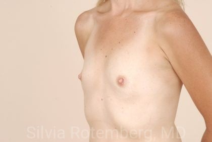 Breast Augmentation Before & After Patient #379