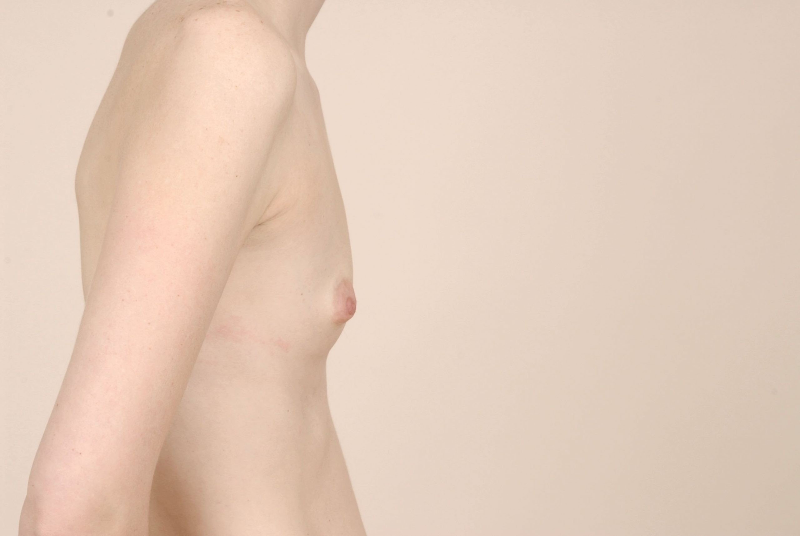 Breast Augmentation Before & After Patient #391