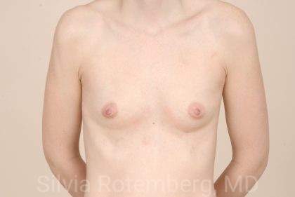 Breast Augmentation Before & After Patient #391