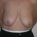 Breast Reduction Before & After Patient #608