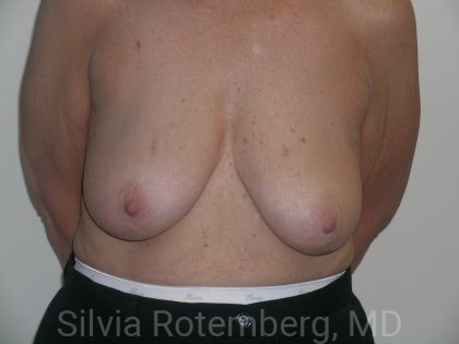 Breast Reduction Before & After Patient #608
