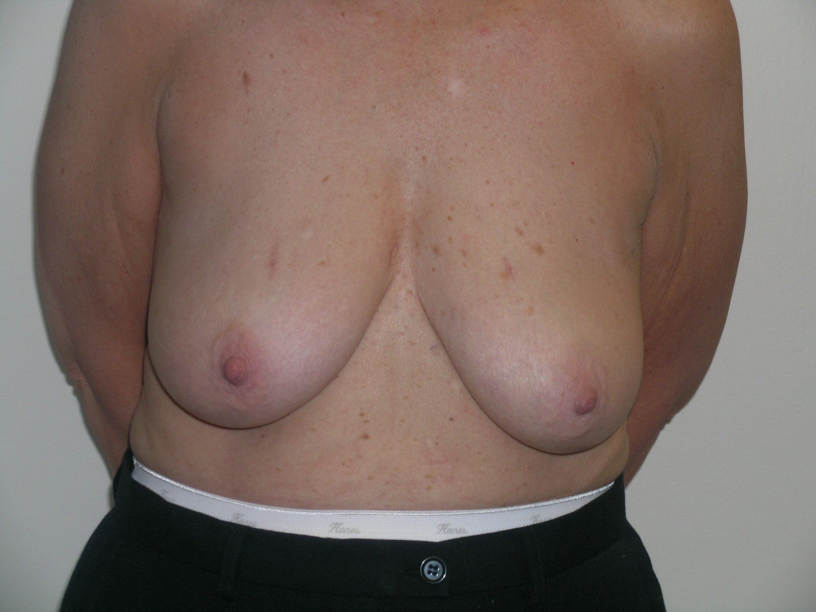 Breast Reduction Before & After Patient #608