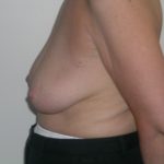Breast Reduction Before & After Patient #608