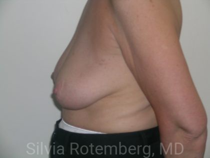 Breast Reduction Before & After Patient #608