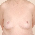 Breast Reduction Before & After Patient #608