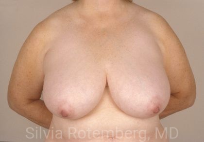 Breast Reduction Before & After Patient #552