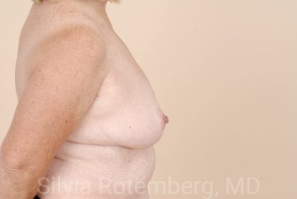 Breast Reduction Before & After Patient #552