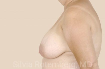 Breast Reduction Before & After Patient #621