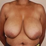 Breast Reduction Before & After Patient #557