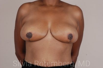 Breast Reduction Before & After Patient #557