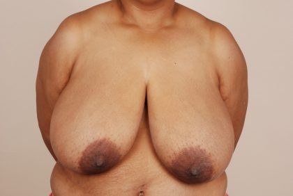 Breast Reduction Before & After Patient #648
