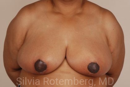 Breast Reduction Before & After Patient #648