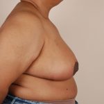 Breast Reduction Before & After Patient #648