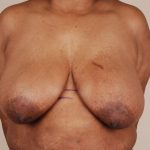 Breast Reduction Before & After Patient #653