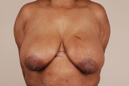 Breast Reduction Before & After Patient #653
