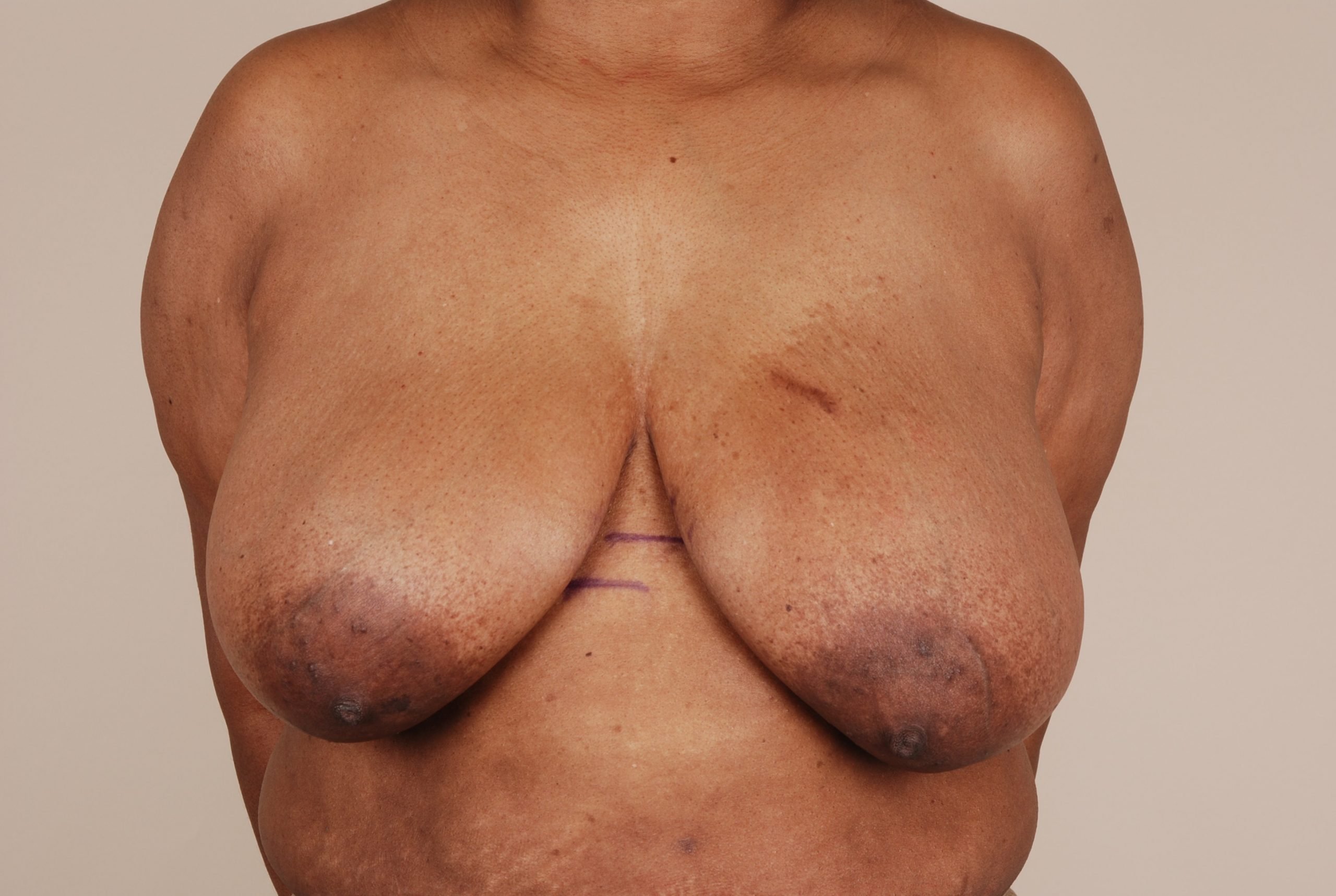 Breast Reduction Before & After Patient #653