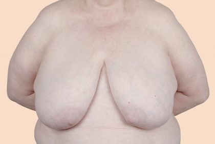 Breast Reduction Before & After Patient #657