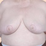 Breast Reduction Before & After Patient #657