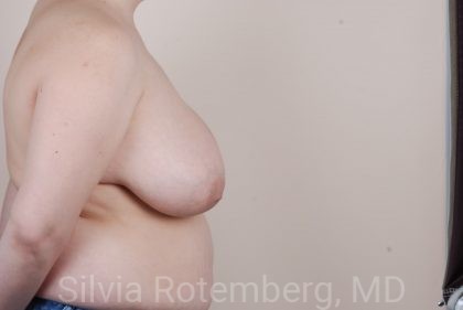 Breast Reduction Before & After Patient #664