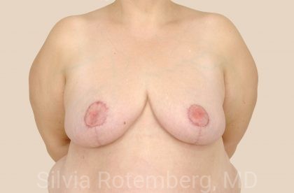 Breast Reduction Before & After Patient #669