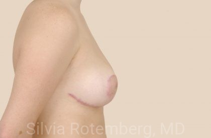 Breast Reduction Before & After Patient #565