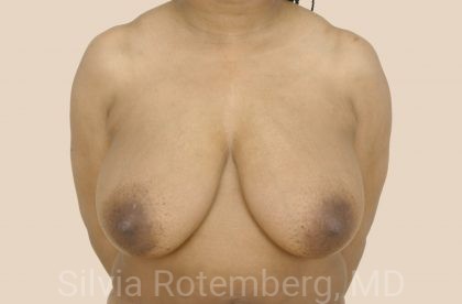 Breast Reduction Before & After Patient #680