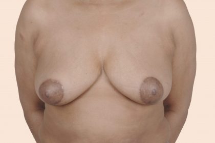 Breast Reduction Before & After Patient #680