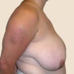 Breast Reduction Before & After Patient #570