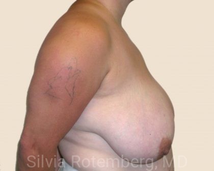 Breast Reduction Before & After Patient #570