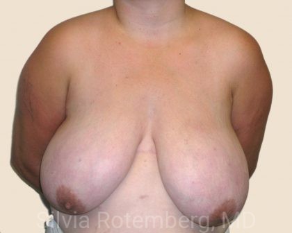 Breast Reduction Before & After Patient #570