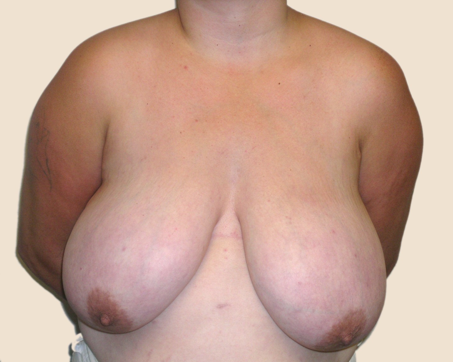 Breast Reduction Before & After Patient #570