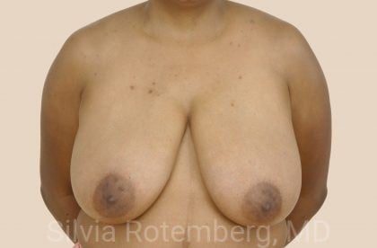 Breast Reduction Before & After Patient #575