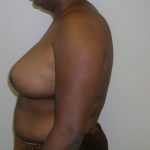 Breast Reduction Before & After Patient #575