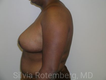 Breast Reduction Before & After Patient #575