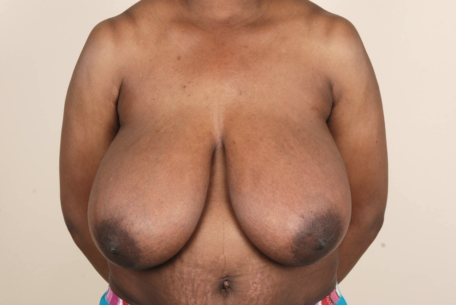 Breast Reduction Before & After Patient #695