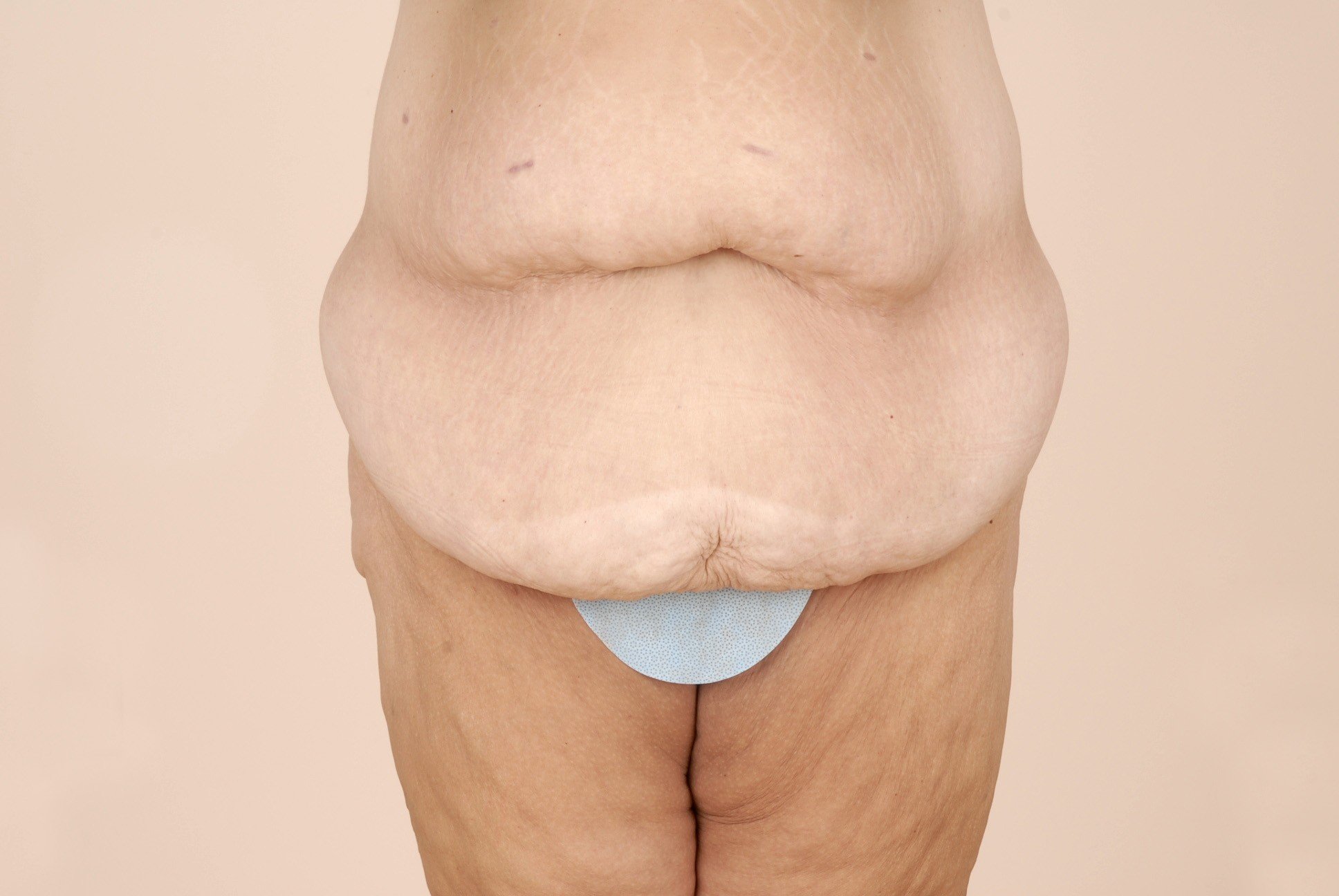 Body Lift Before & After Patient #522