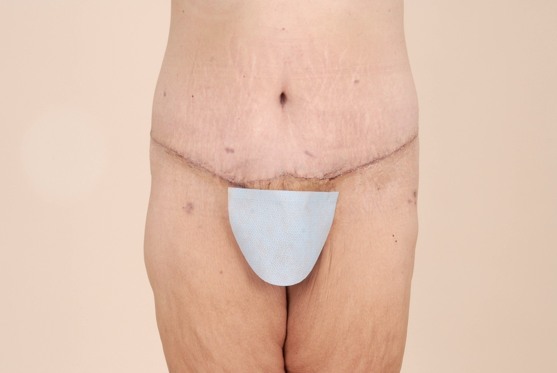 Body Lift Before & After Patient #522