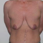 Breast Lift Before & After Patient #363